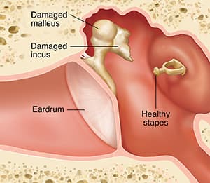 Ossicular dysfunction