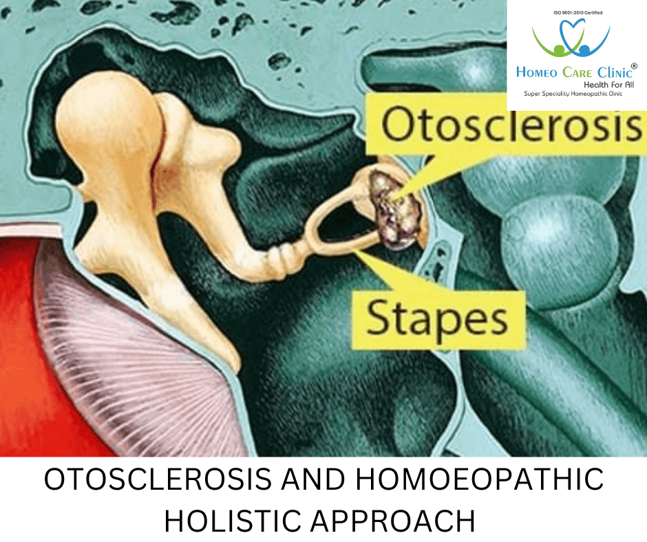 Otosclerosis